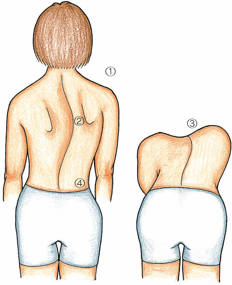 側彎症の解説図　洲本接骨院側彎症ページ資料